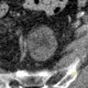 Fibrolipoma in pelvis: CT - Computed tomography